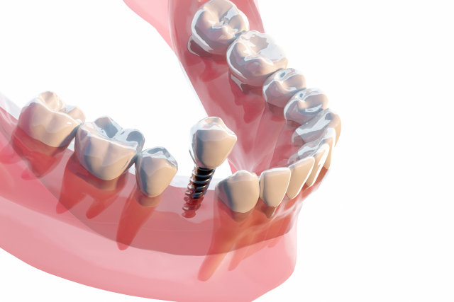 外苑前（東京）の歯医者、Angel矯正歯科・歯科口腔外科でインプラント
