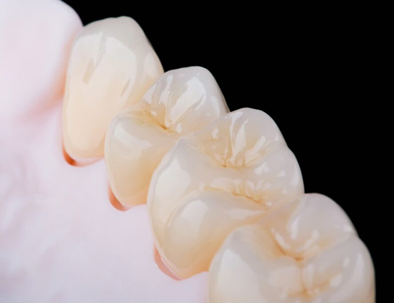 外苑前（東京）の歯医者、Angel矯正歯科・歯科口腔外科のセレック(CEREC)治療