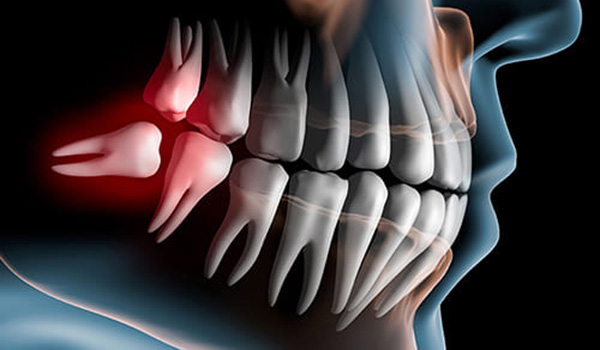 外苑前（東京）の歯医者、Angel矯正歯科・歯科口腔外科で歯科用CT精密診断