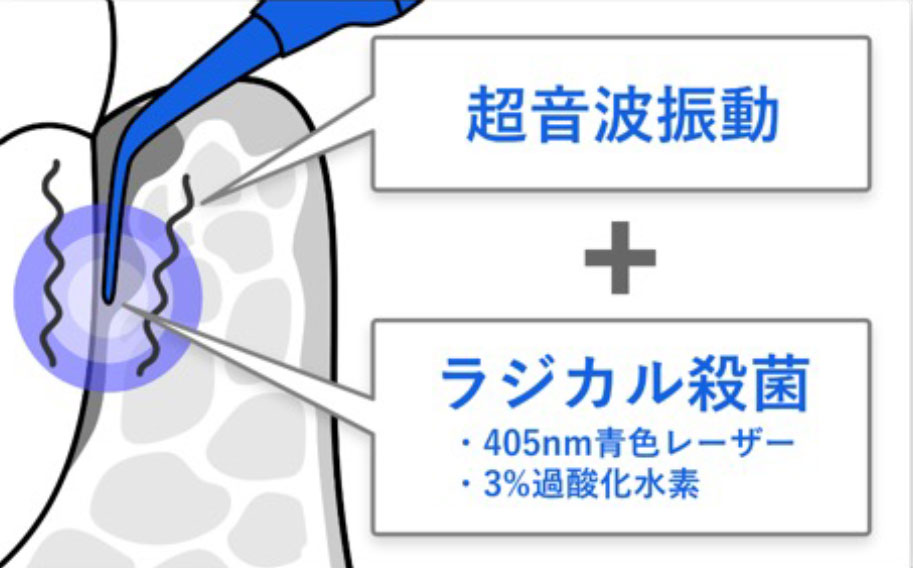 外苑前（東京）の歯医者、Angel矯正歯科・歯科口腔外科でブルーラジカル治療