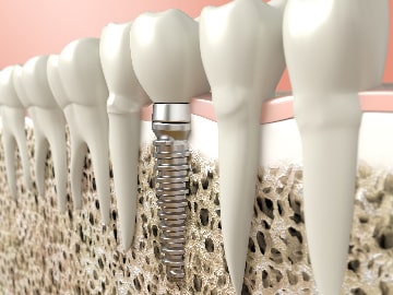 外苑前（東京）の歯医者、Angel矯正歯科・歯科口腔外科で歯科用CT精密診断