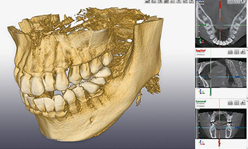 外苑前（東京）の歯医者、Angel矯正歯科・歯科口腔外科で歯科用CT精密診断