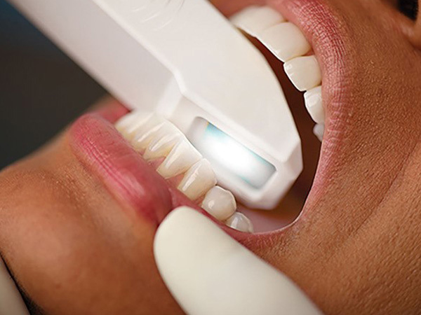 外苑前（東京）の歯医者、Angel矯正歯科・歯科口腔外科の口腔内スキャナーiTero(アイテロ)