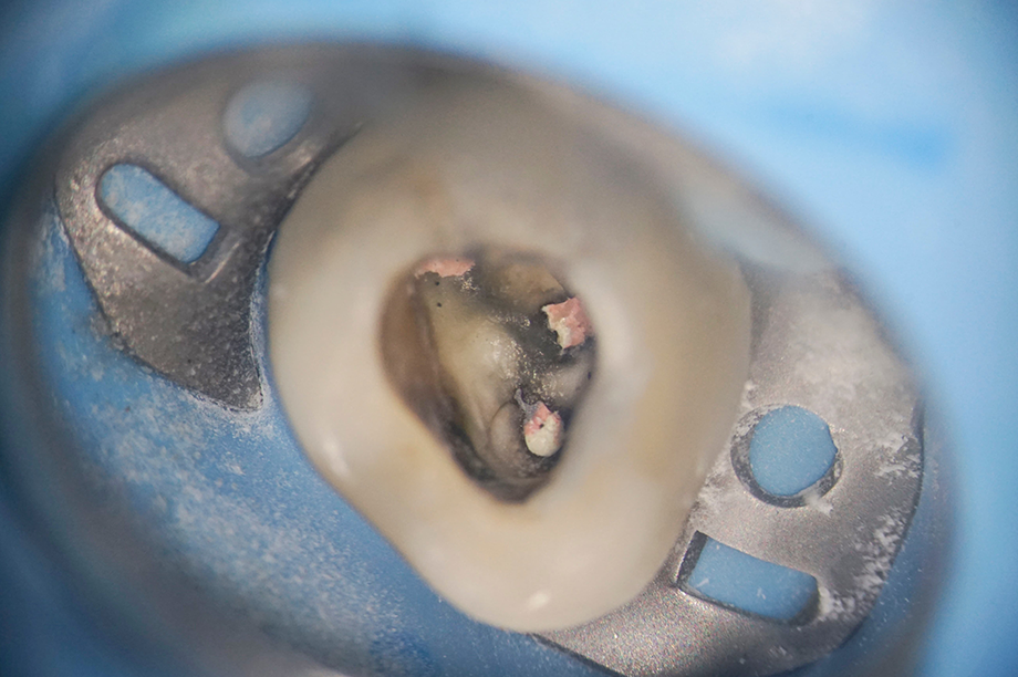 外苑前（東京）の歯医者、Angel矯正歯科・歯科口腔外科でマイクロスコープ精密治療