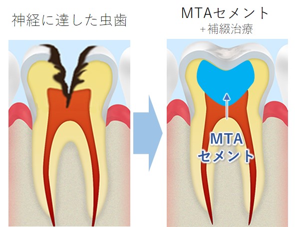 外苑前（東京）の歯医者、Angel矯正歯科・歯科口腔外科のMTAセメント