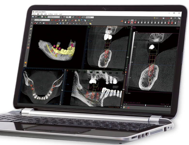 外苑前（東京）の歯医者、Angel矯正歯科・歯科口腔外科でインプラント