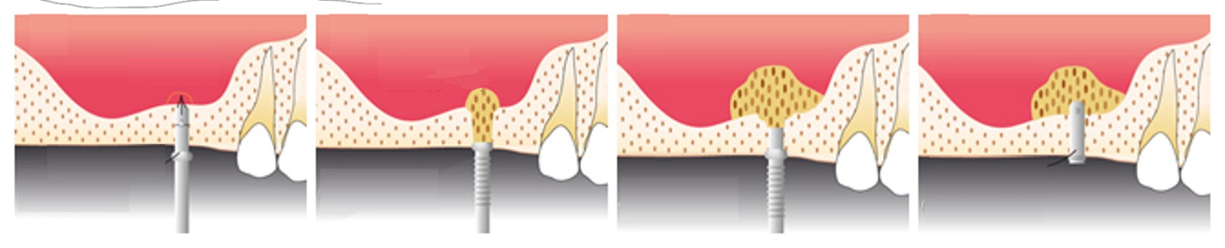 外苑前（東京）の歯医者、Angel矯正歯科・歯科口腔外科でインプラント